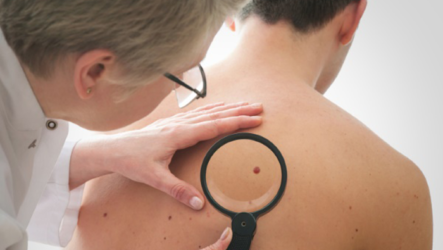 Is a papilloma on the back dangerous: causes and treatment